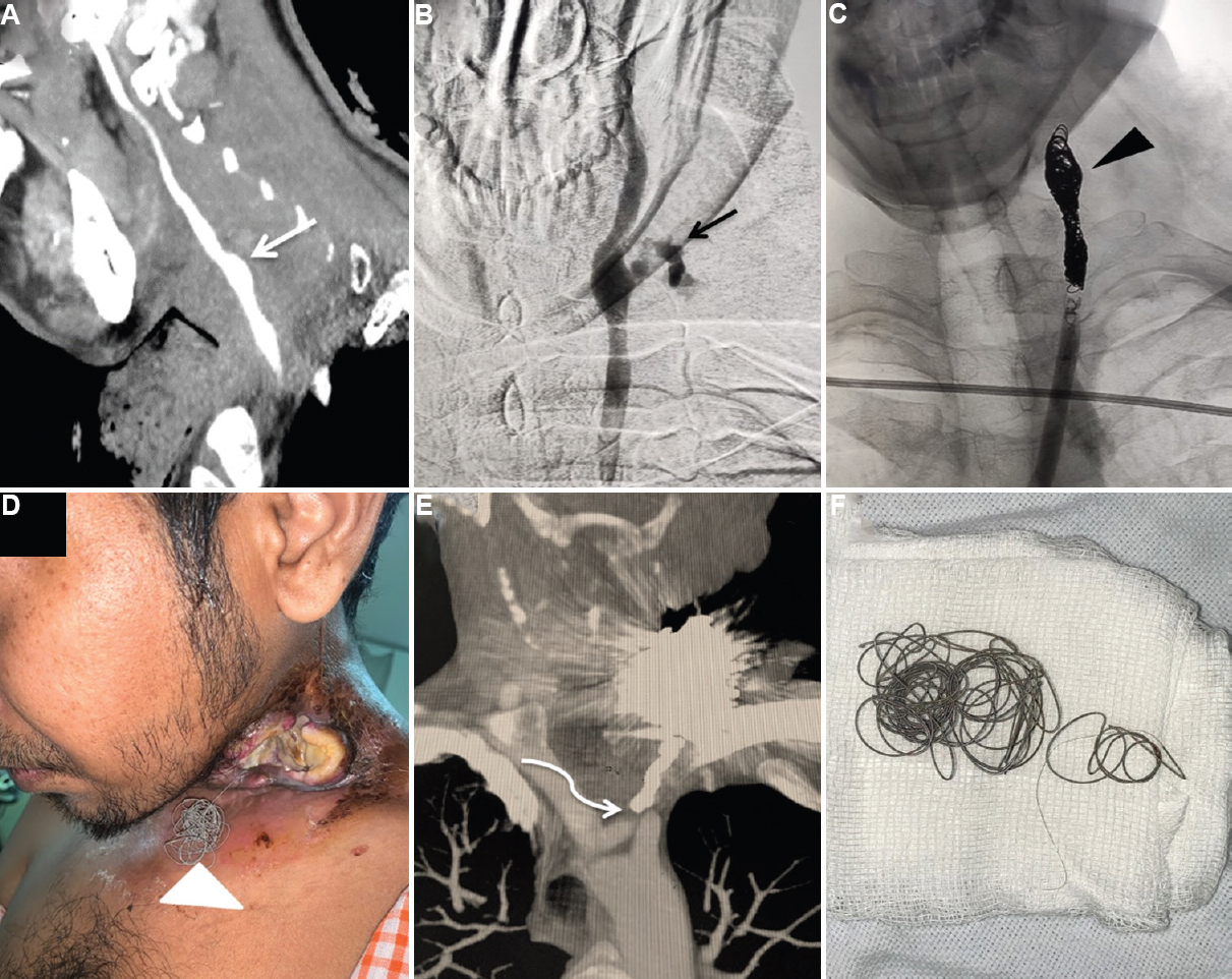 Sagittal (A) maximum intensity projection computed tomography (CT) angiography image depicting focal dilatation of the carotid bulb (white arrow) confirmed on (B) catheter digital subtraction angiogram with active contrast extravasation suggestive of blowout (black arrow). Control digital subtraction angiogram image following coil embolization (C) showing coil mass (black arrowhead) in situ with cessation of the contrast efflux. Clinical photograph (D) showing hanging coil mass from the open neck wound (white arrowhead). (E) CT angiography depicting left common carotid thrombosis (curved arrow). (F) Actual extruded microcoil mass.
